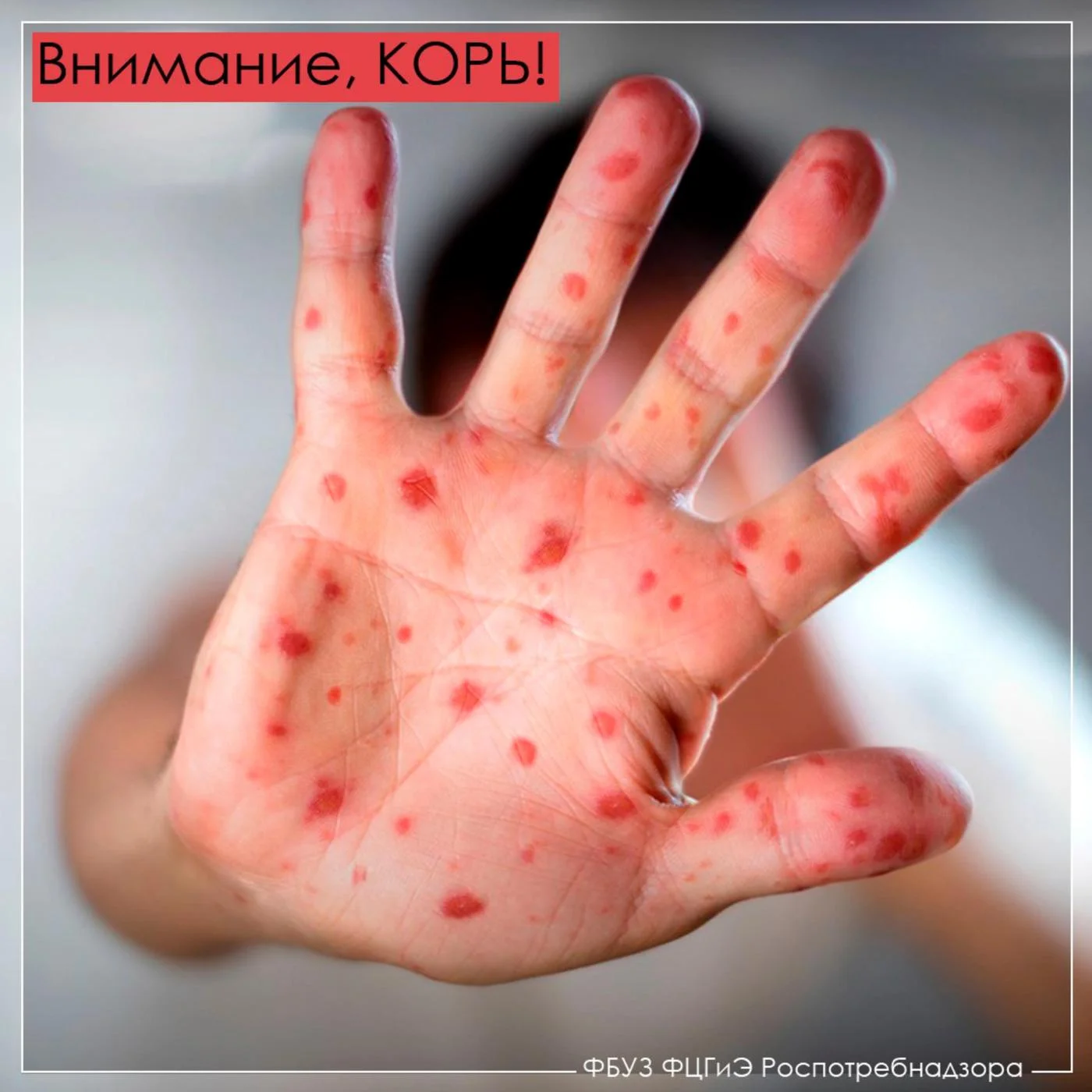 Внимание, КОРЬ! Информация и рекомендации для профилактики и лечения.